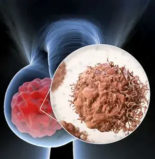 Câncer de Testículo: Entenda, Previna e Saiba Quando Procurar Ajuda Médica