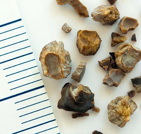 Cálculos Urinários (Pedras nos Rins): Um Guia Completo da Urolages para Entender e Tratar