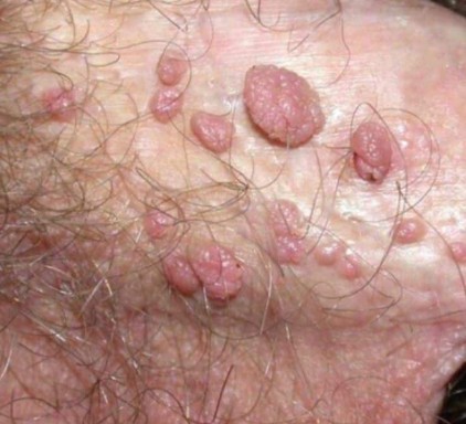 HPV nos Homens